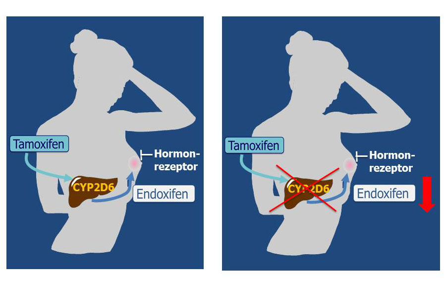 Frauen, die eine eingeschränkte Aktivität des Enzyms Cytochrom P450 2D6 (CYP2D6) aufweisen, können Tamoxifen nicht ausreichend zu Endoxifen umsetzen. Ihnen könnte zukünftig helfen, wenn sie eine zusätzliche Dosis Endoxifen erhalten.