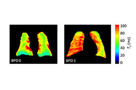 Zwei MRT-Aufnahmen der Lunge. Die ausgeprägte rote Färbung im rechten MRT-Bild weist auf eine bronchopulmonale Dysplasie hin.